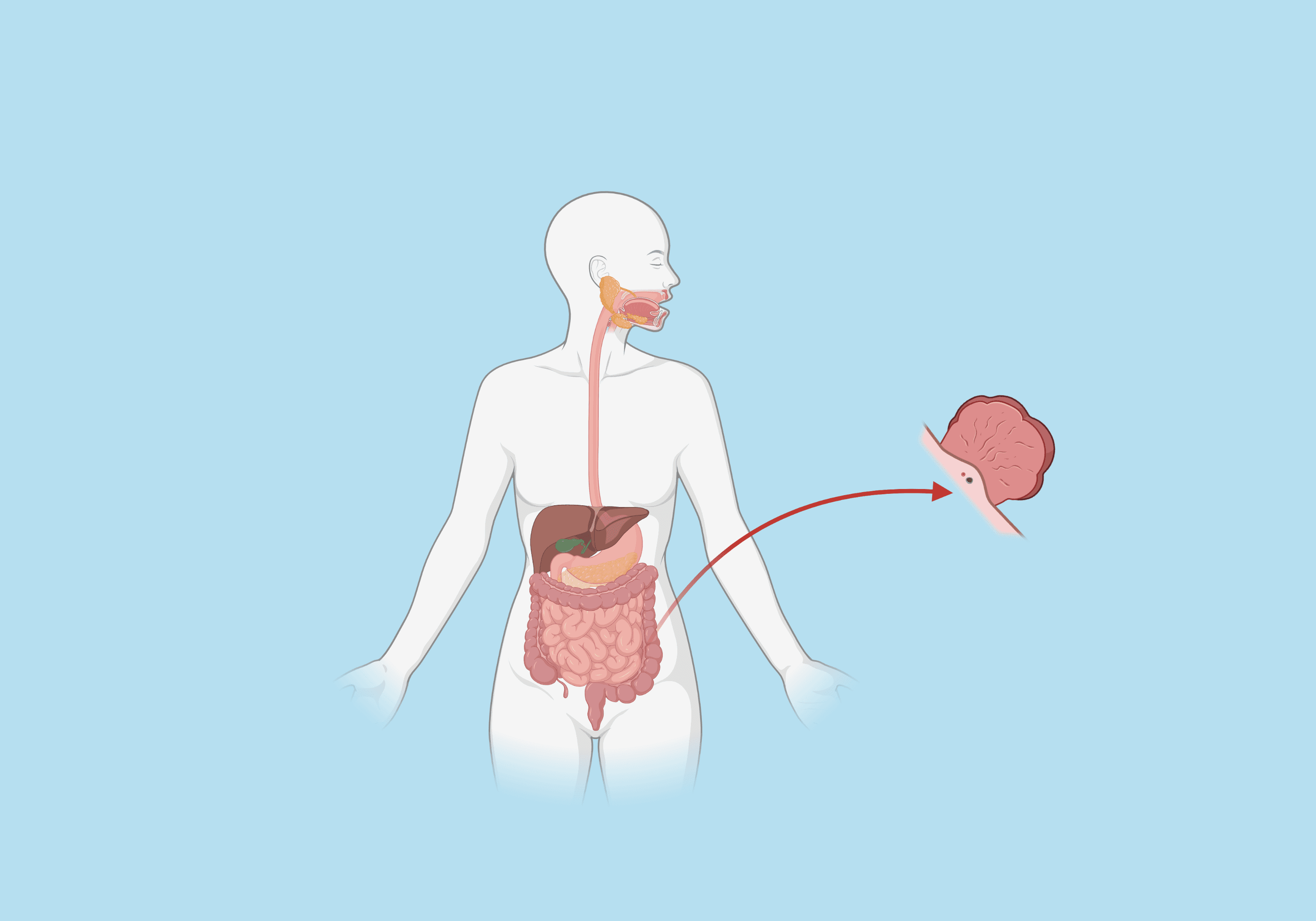Adenomas de Cólon: Entendendo o Risco e a Prevenção do Câncer Colorretal