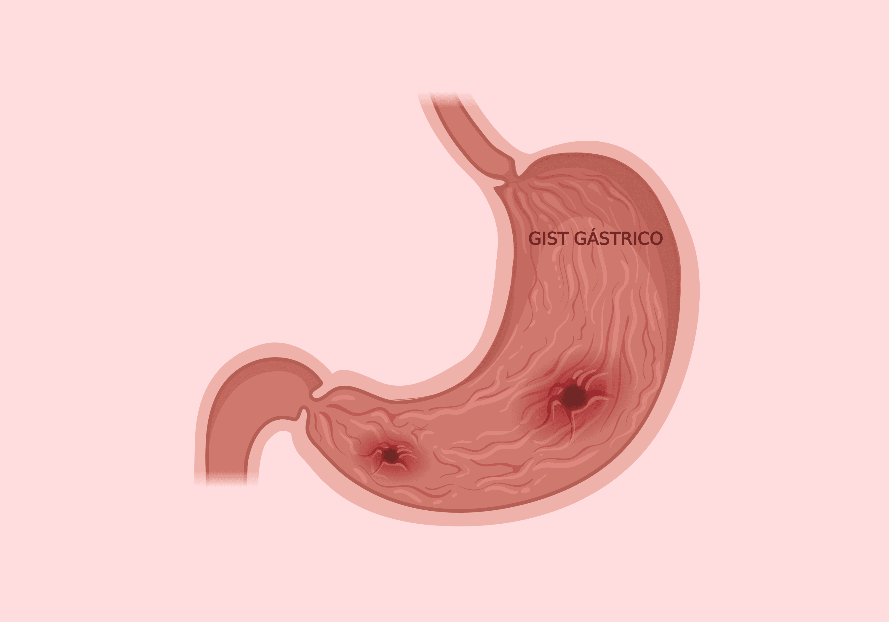 GIST Gástrico: Conheça esse Raro Tumor no Estômago e suas Implicações